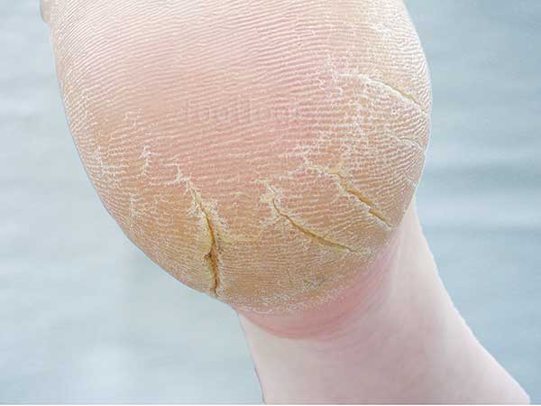 Looking After Your Feet in a Heatwave