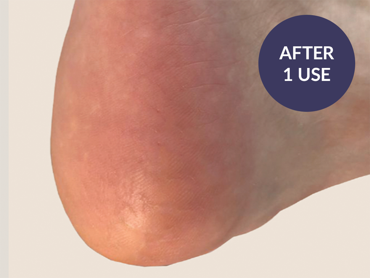 Why Is the Skin on My Feet Peeling and How Do I Fix It?